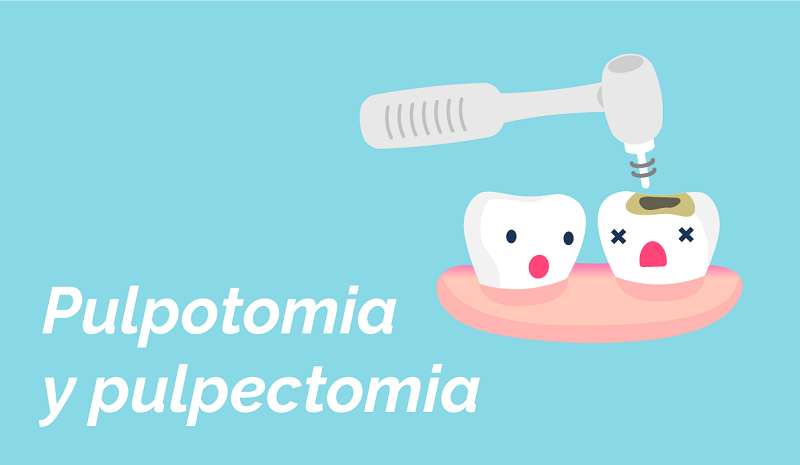 ¿Que es la pulpotomia y la pulpectomia?