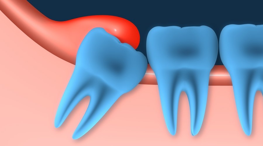 Dientes impactados.